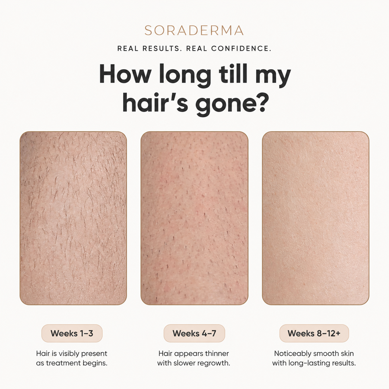 Soraderma results timeline: weeks 1-3, 4-7, and 8-12+