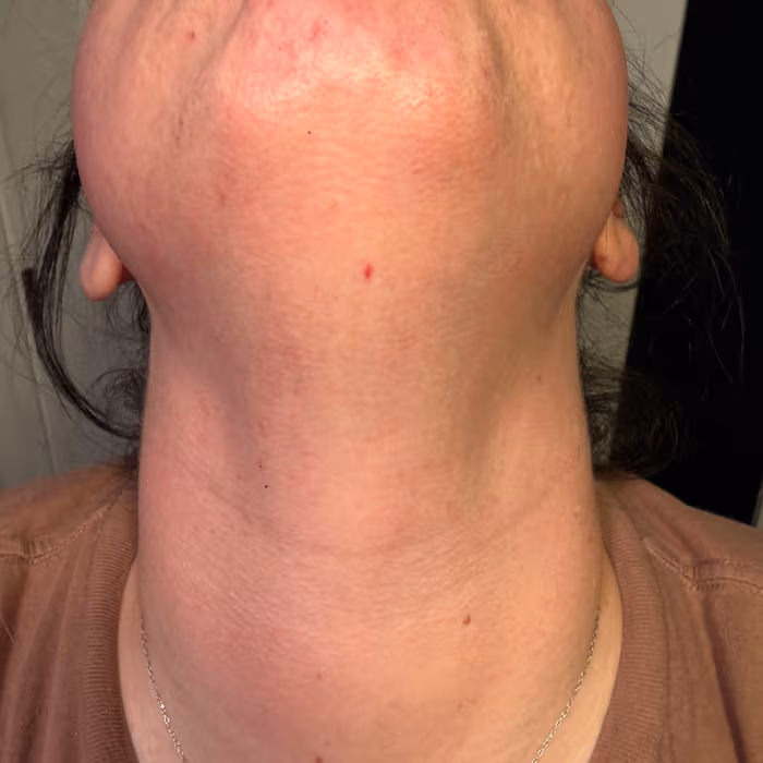 Chin & Neck after 4 weeks
