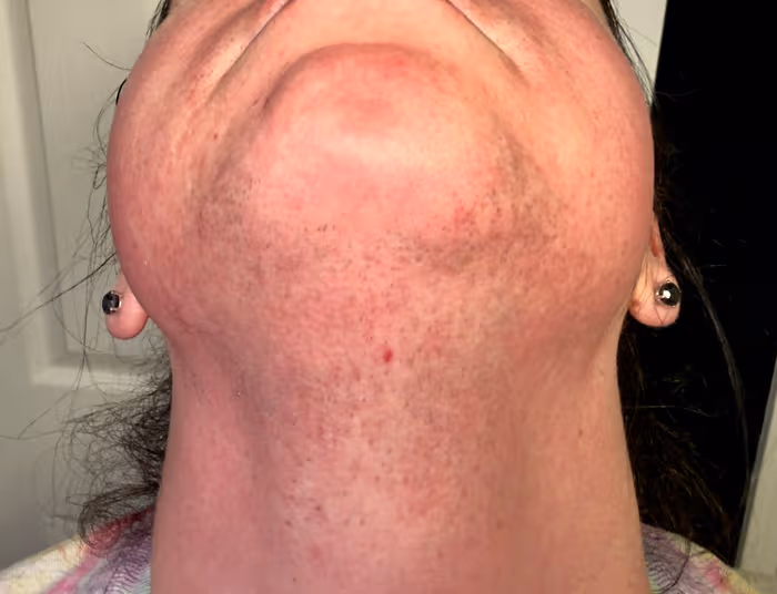 Chin & Neck before treatment