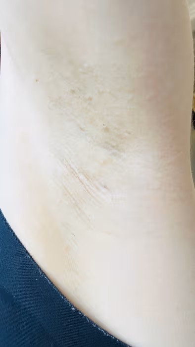 Underarms after 5 weeks