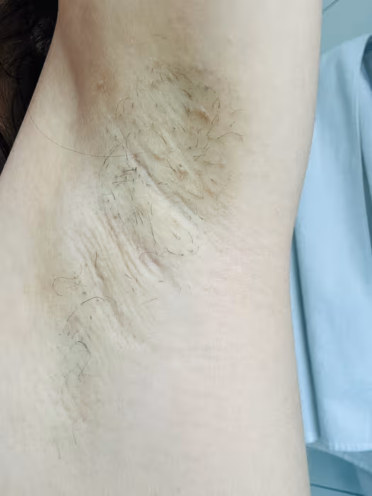 Underarms before treatment